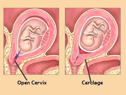 cervical-incompetence