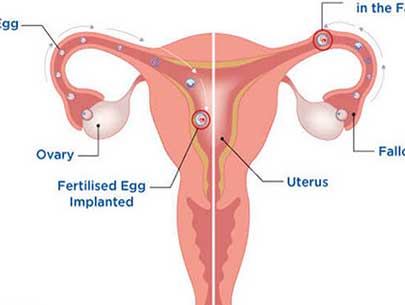 Ectopic Pregnancy