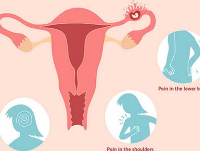 Ectopic Pregnancy