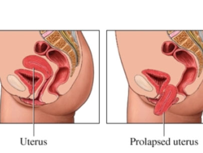 Pregnancy with prolapse