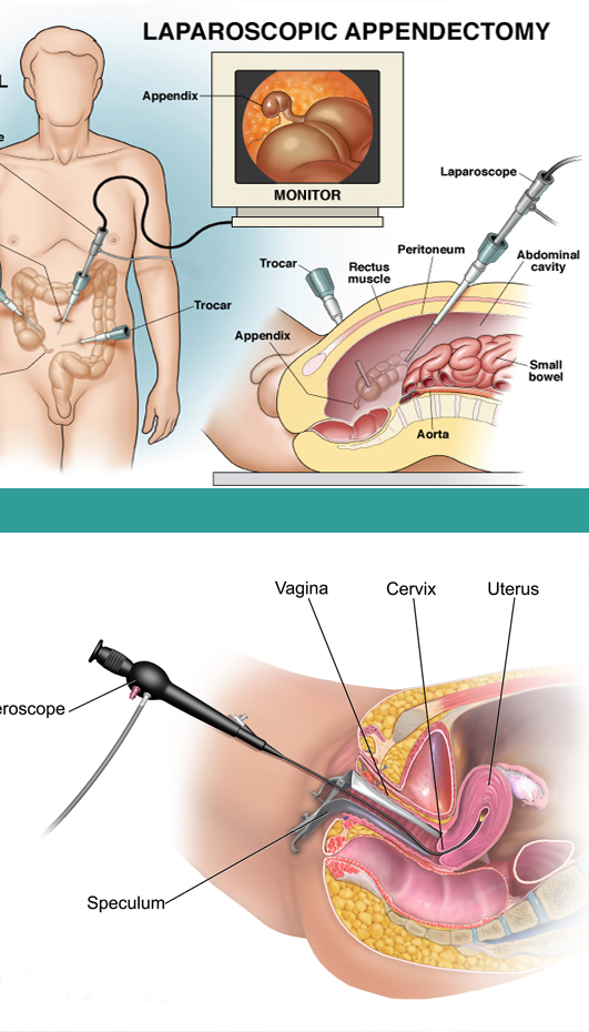 hysteroscopy