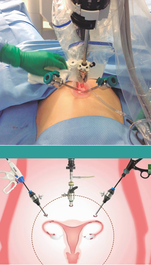 Laparoscopic Hysterectomy