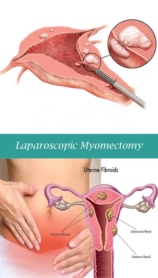 Laparoscopic Myomectomy