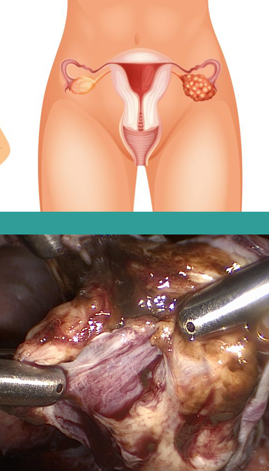 laparoscopic ovarian cystectomy